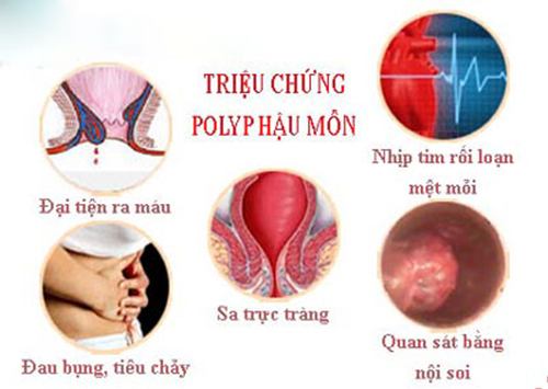 triệu chứng polyp hậu môn