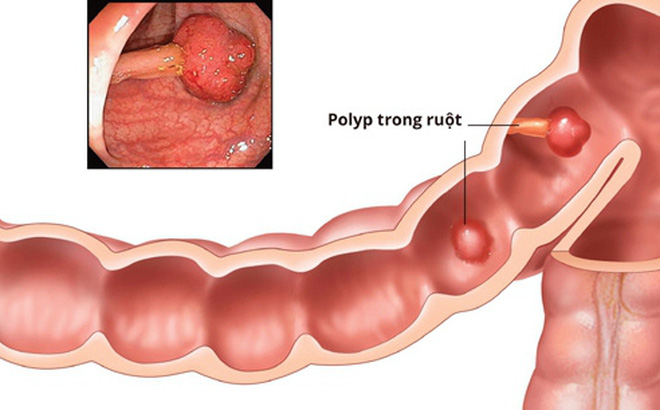 polyp đại tràng gây táo bón thường xuyên