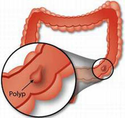 polyp hậu môn là gì
